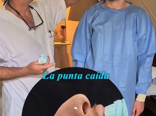Rinoplastia - Dr. Damián Wengrowicz