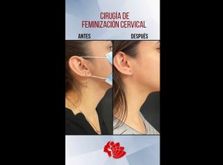 Feminización del rostro - Dr. Emmanuel Manavela Chiapero
