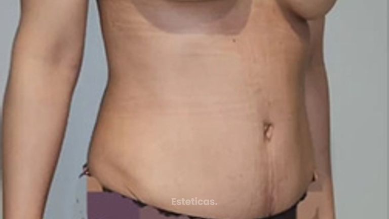 Abdominoplastia con lipoescultura dorsal y mastopexia - Dr. Juan Ignacio Balestrelli