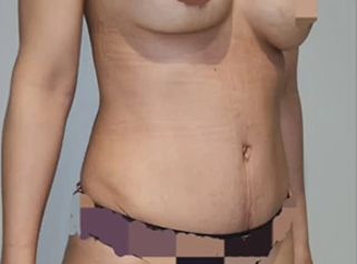 Abdominoplastia con lipoescultura dorsal y mastopexia - Dr. Juan Ignacio Balestrelli