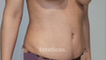 Abdominoplastia con lipoescultura dorsal y mastopexia - Dr. Juan Ignacio Balestrelli