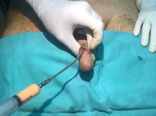 Relleno de grasa en pene