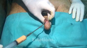 Relleno de grasa en pene