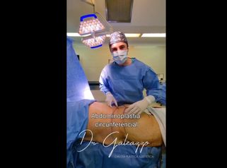 Abdominoplastia circunferencial - Dr. Damián Galeazzo y Equipo